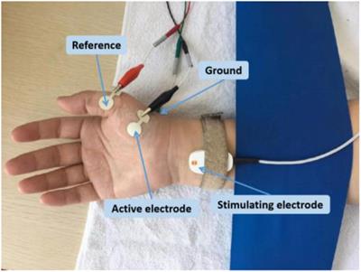 MScanFit motor unit number estimation of abductor pollicis brevis: Findings from different experimental parameters